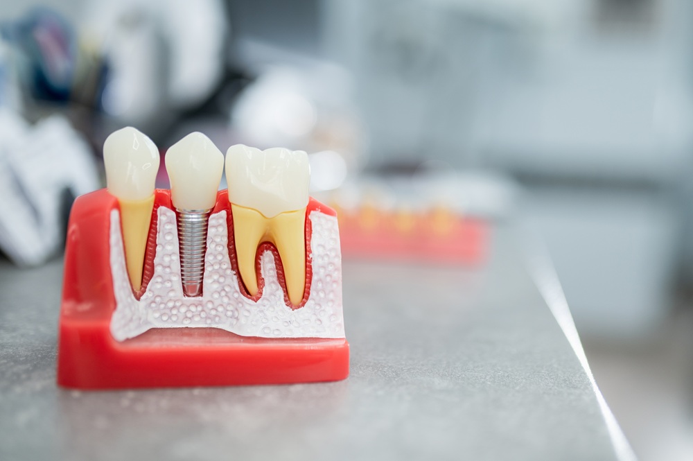 Jak wygląda proces wszczepienia implantów krok po kroku?
